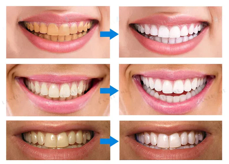 Lápiz Blanqueador de Dientes